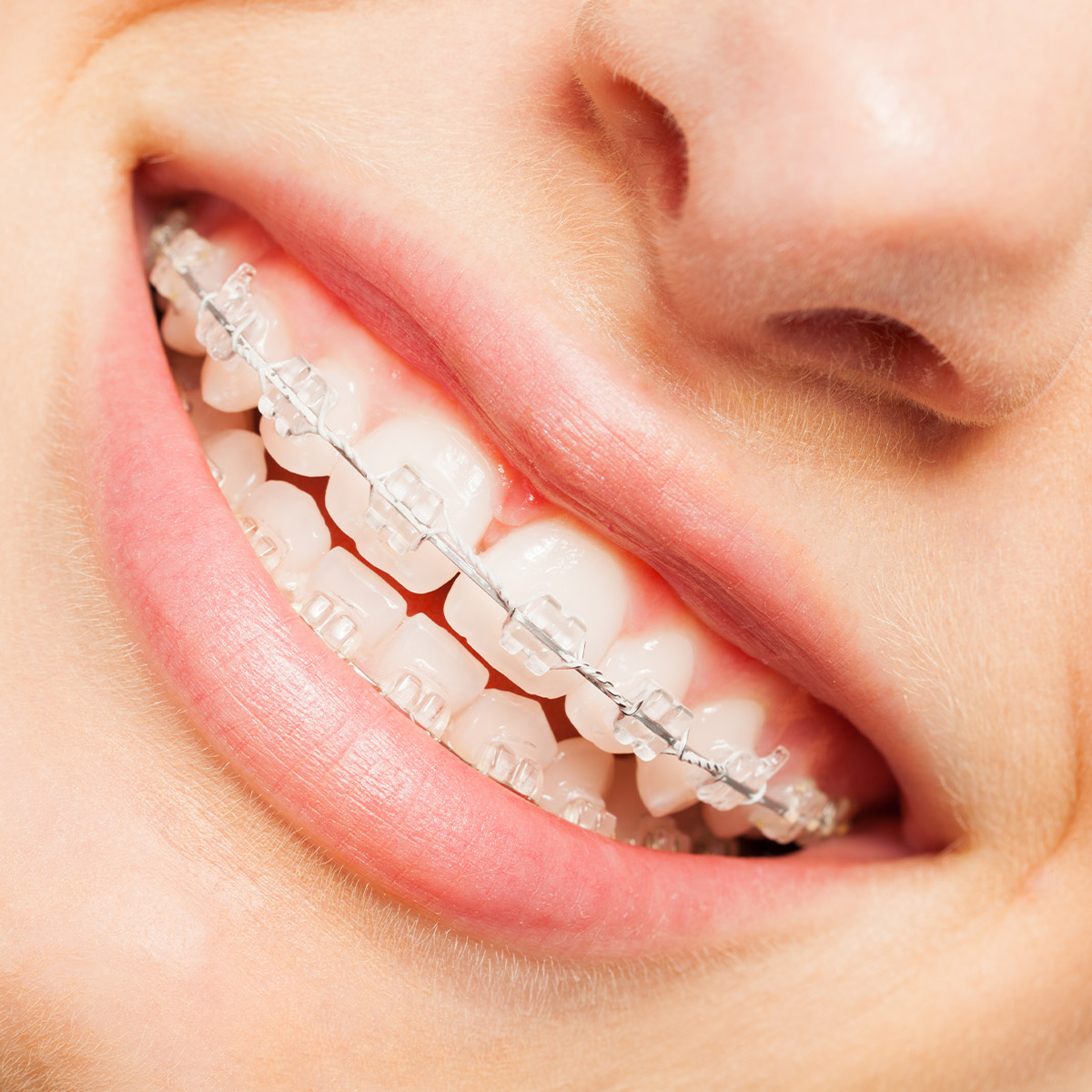 Invisalign/Six Month Smiles - Medora Dental Care