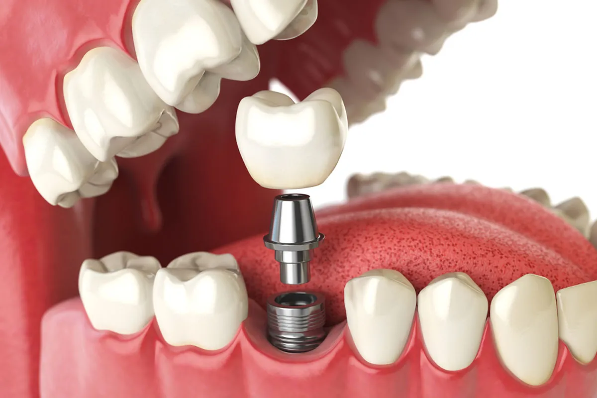How Do Dental Implants Work? Complete Step-by-Step Process