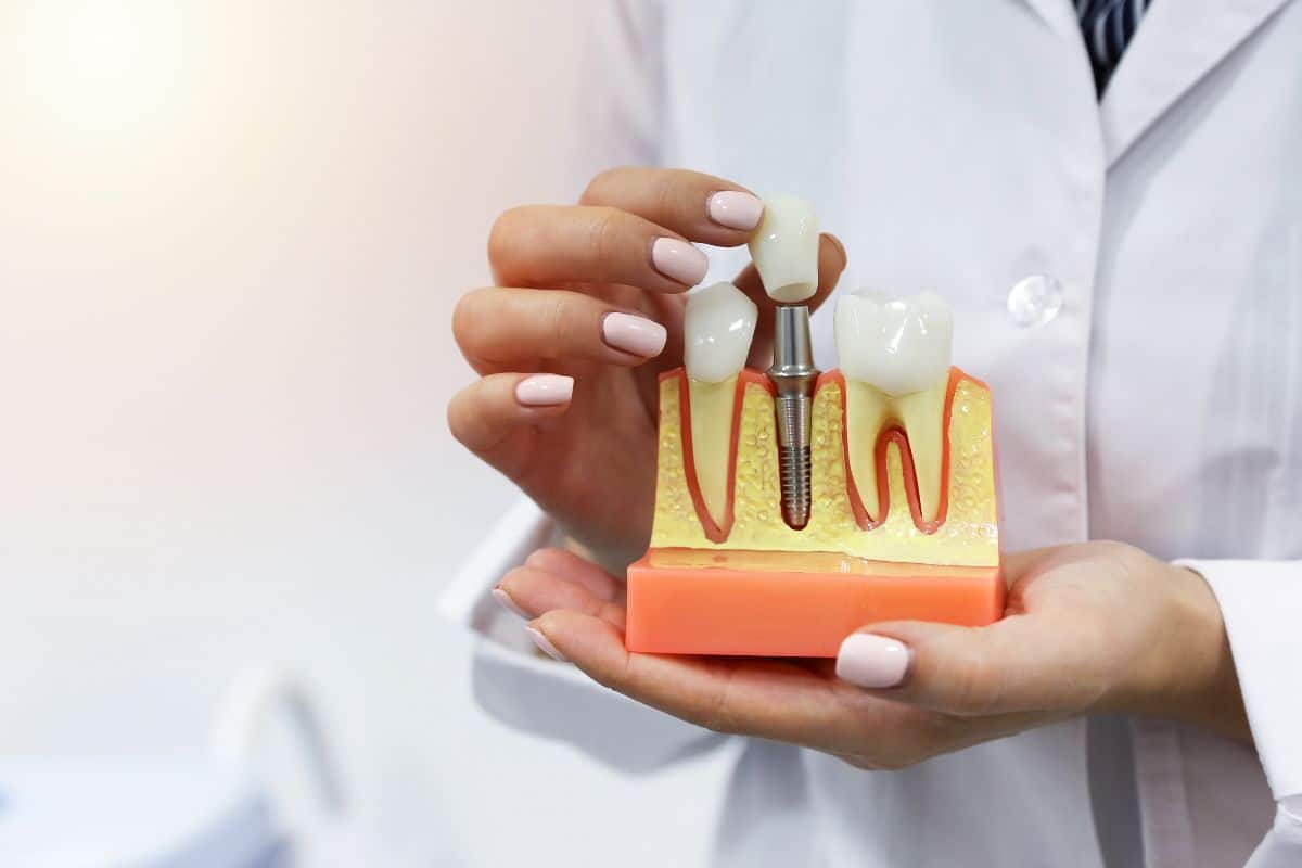 How to Care for Dental Implants After Surgery (Complete Recovery & Aftercare Guide)