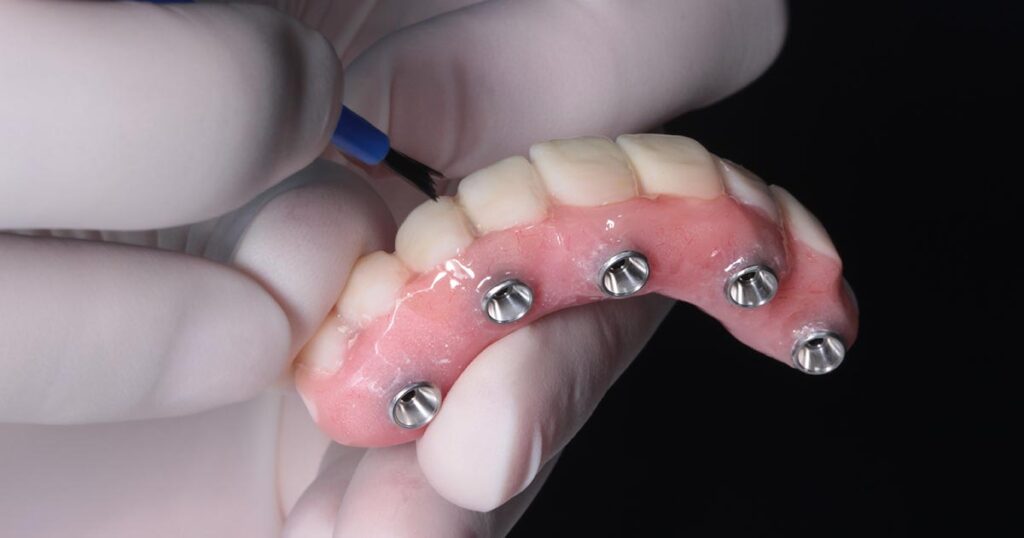 All-on-4 Dental Implant