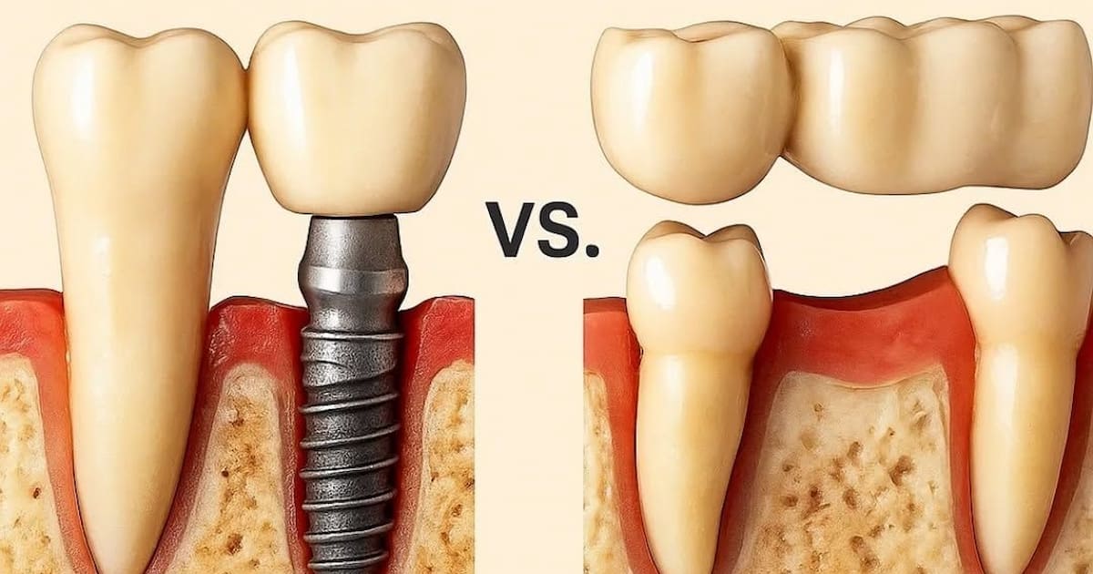 Dental Implants vs. Dental Bridges
