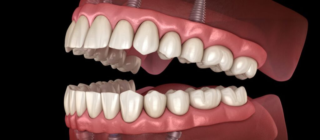 Top 7 Dental Implant Myths Debunked