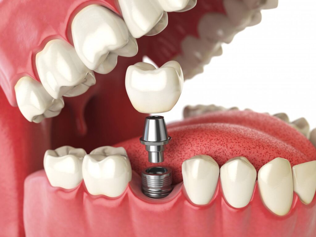 dental implants cost abbotsford