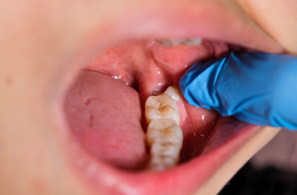 Wisdom Teeth: Everything You Need to Know