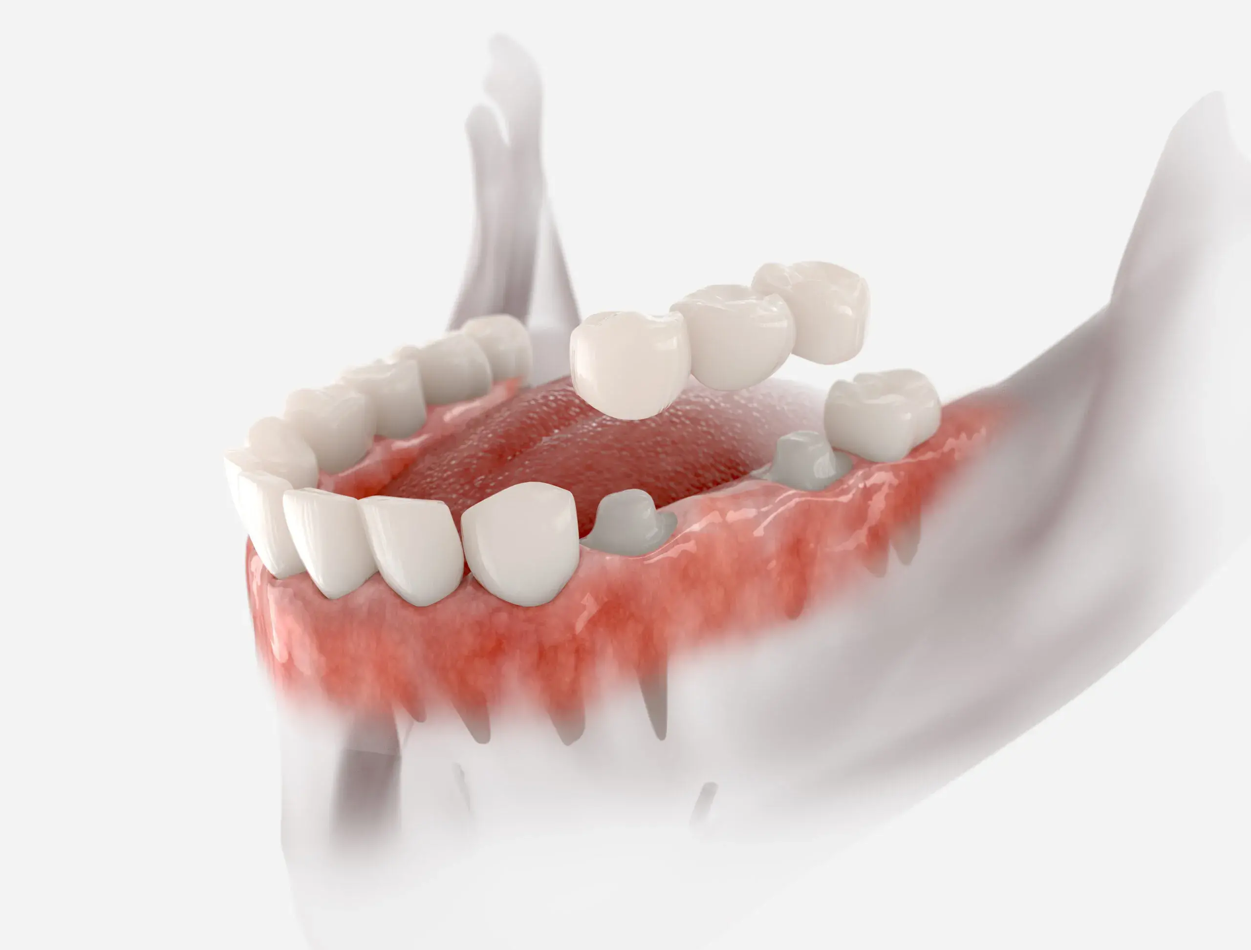 How Long Do Dental Bridges Last?
