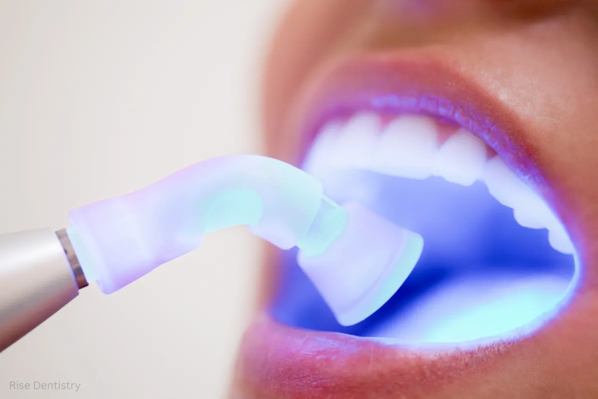 How Much Does a Dental Bridge Cost in 2026? Complete Price Guide