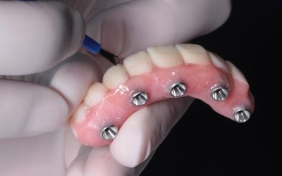 All-on-4 Dental Implant