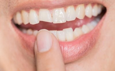 How to Handle a Broken Tooth: Immediate Steps to Take 