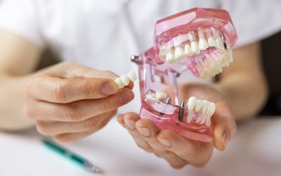 Can You Eat Normally with a Dental Bridge? What You Need to Know 