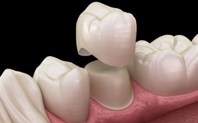 Is Getting a Crown Painful? What to Expect at the Dentist 