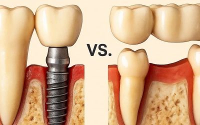Dental Implants vs. Dental Bridges
