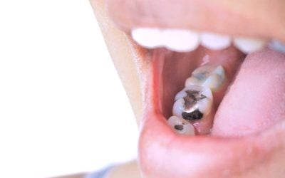 How do you know if a filling needs replacing? Expert Tips and Signs