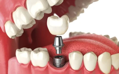 How Do Dental Implants Work? Complete Step-by-Step Process