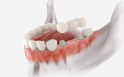 How Long Do Dental Bridges Last?