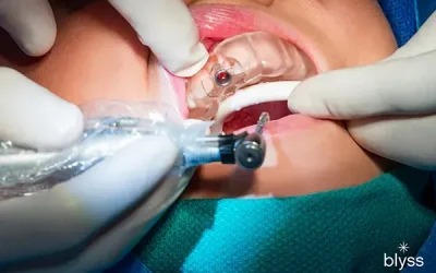 How Painful Are Dental Implants? Full Patient Guide