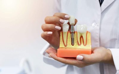 How to Care for Dental Implants After Surgery (Complete Recovery & Aftercare Guide)