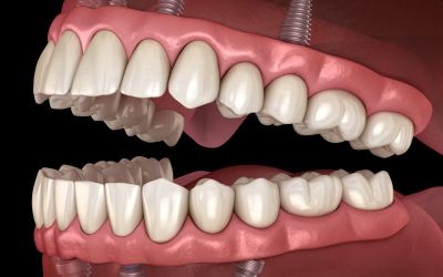Top 7 Dental Implant Myths Debunked