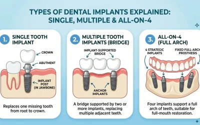Types of Dental Implants Explained: Single, Multiple & All-on-4