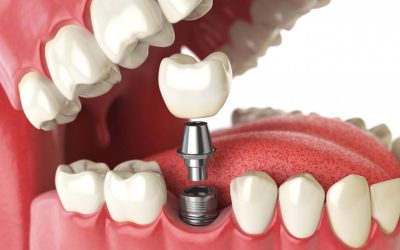 dental implants cost abbotsford