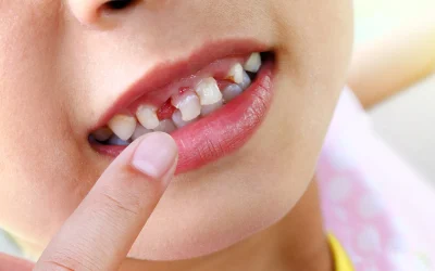 Dental Implants in Abbotsford BC – The Complete 2026 Guide to Replacing Missing Teeth